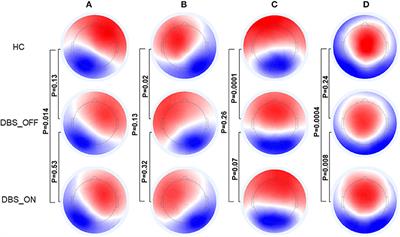 Dysfunctional Brain Dynamics of Parkinson's Disease and the Effect of Acute Deep Brain Stimulation